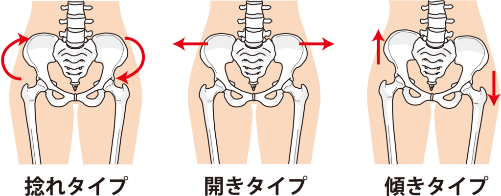 骨盤の歪みには、ねじれタイプや開きタイプ、傾きタイプなど様々なタイプがあります。